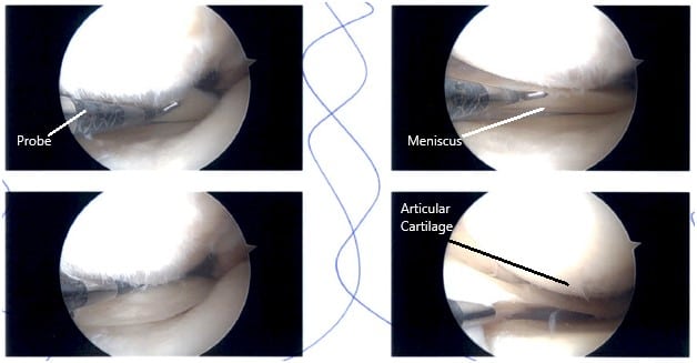 Imágenes de artroscopia intraoperatoria