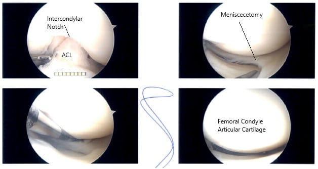Artroscopia intraoperatoria imágenes 2