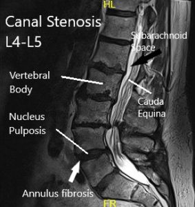 Resonancia magnética de la columna lumbar