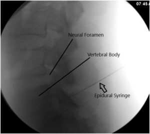 Imágenes de fluoroscopia intraoperatoria