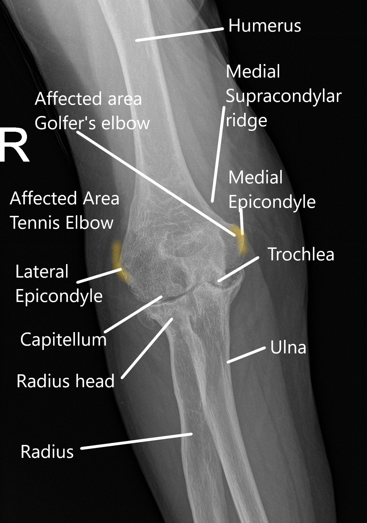 X-ray of the wrist showing various parts of the elbow joint