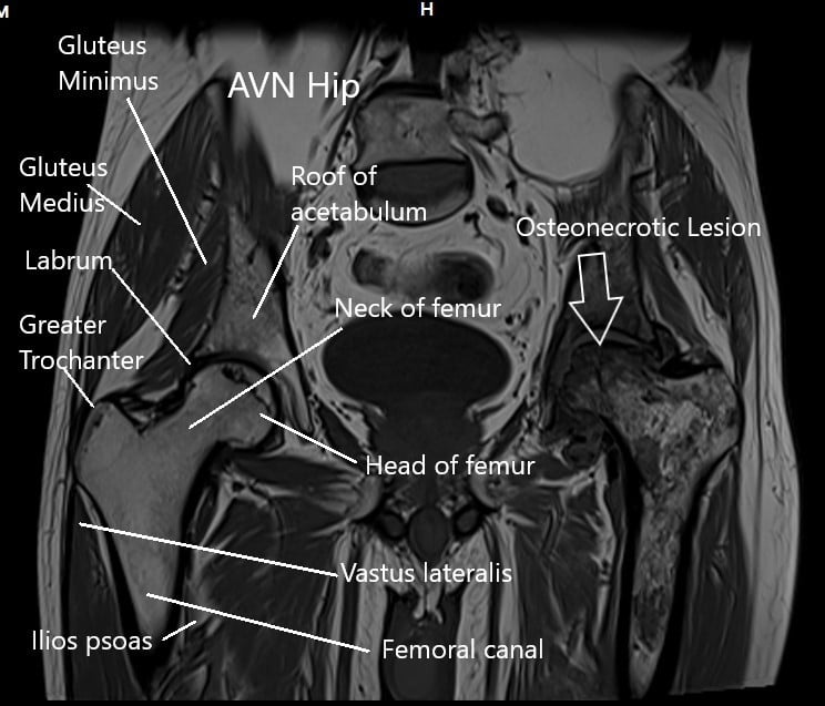MRI of the hip joints in the coronal section MRI of the hip joints in the coronal section
