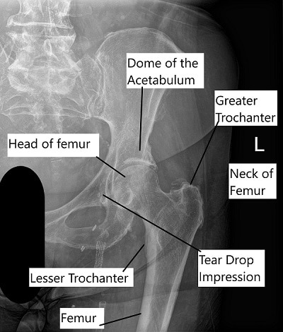 X-ray showing hip anatomy. X-ray showing hip anatomy.
