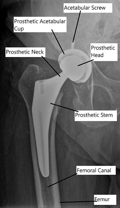 X-ray showing Total Hip Replacement in AP view. X-ray showing Total Hip Replacement in AP view.