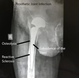 X-ray showing infected hip prosthetic joint. X-ray showing infected hip prosthetic joint.