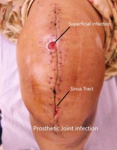 Prosthetic joint infection with redness of the overlying skin and swelling. Prosthetic joint infection with redness of the overlying skin and swelling.