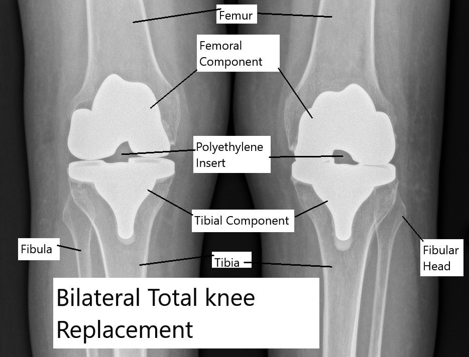 Total knee replacement of both knees. Total knee replacement of both knees.
