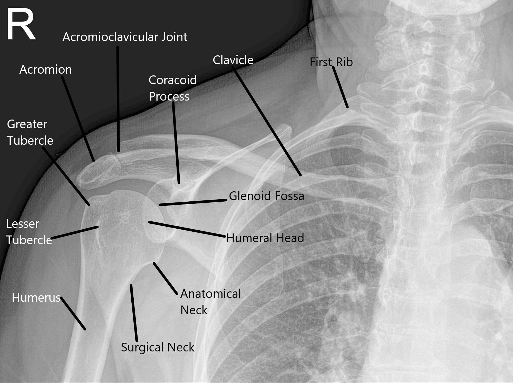 X-ray of the shoulder joint in the AP view X-ray of the shoulder joint in the AP view