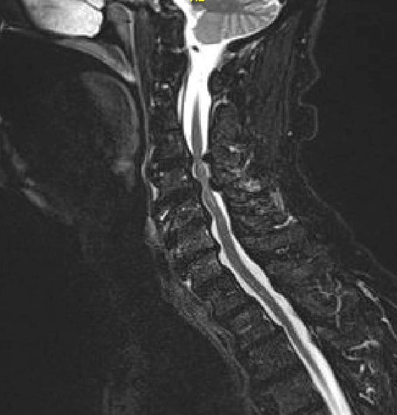 Imagen de resonancia magnética T2 Corte sagital medio que muestra estenosis y compresión graves de la médula espinal en C3-4 y C 5-6 con enfermedad articular degenerativa de la columna cervical