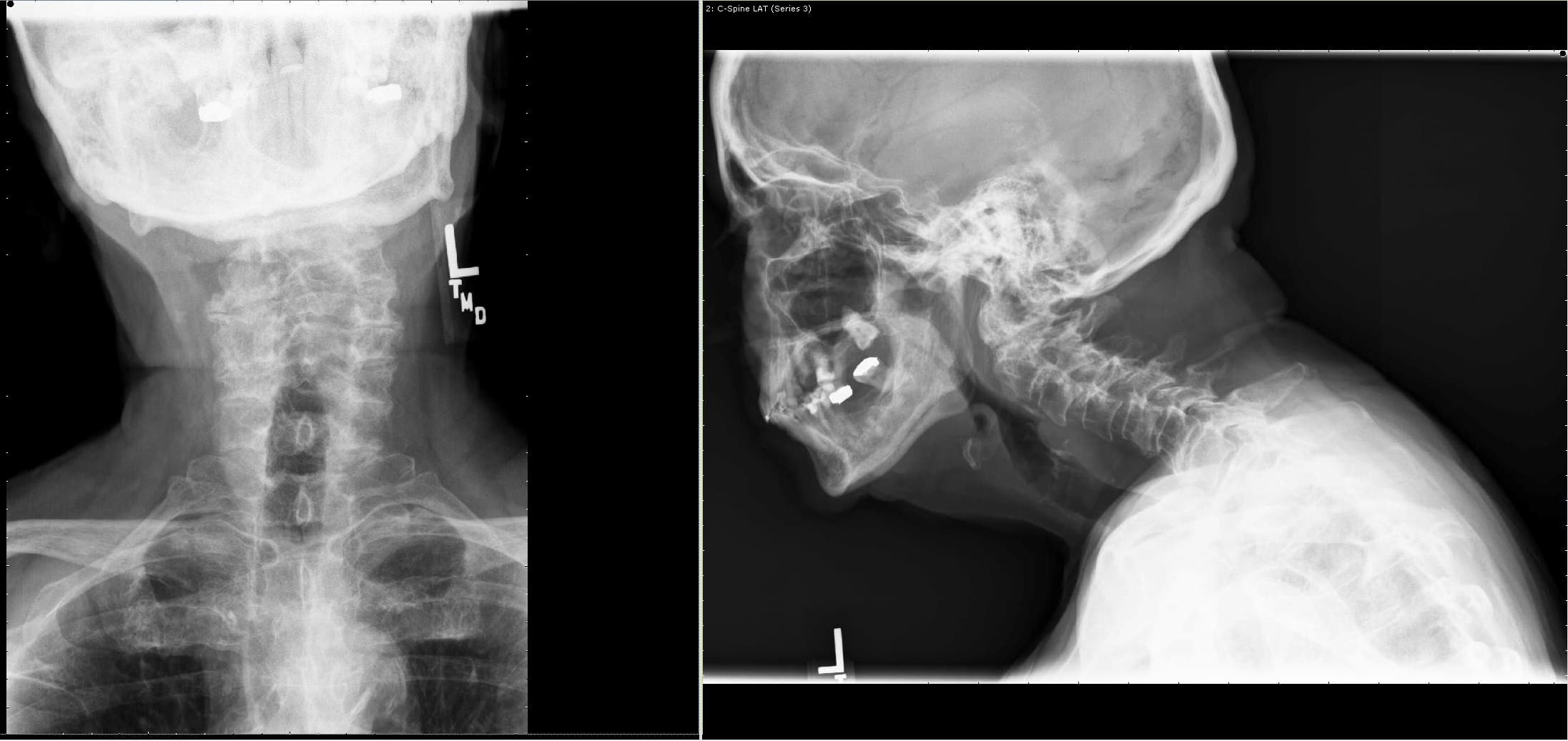 AP y Vista lateral de radiografías que muestran una sospecha de fractura odontoides con inestabilidad en C1-2 AP y Vista lateral de radiografías que muestran una sospecha de fractura odontoides con inestabilidad en C1-2
