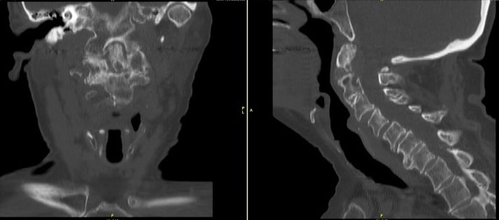 Tomografía computarizada de la columna cervical que muestra la falta de unión del odontoides junto con los cambios degenerativos de la columna cervical Tomografía computarizada de la columna cervical que muestra la falta de unión del odontoides junto con los cambios degenerativos de la columna cervical