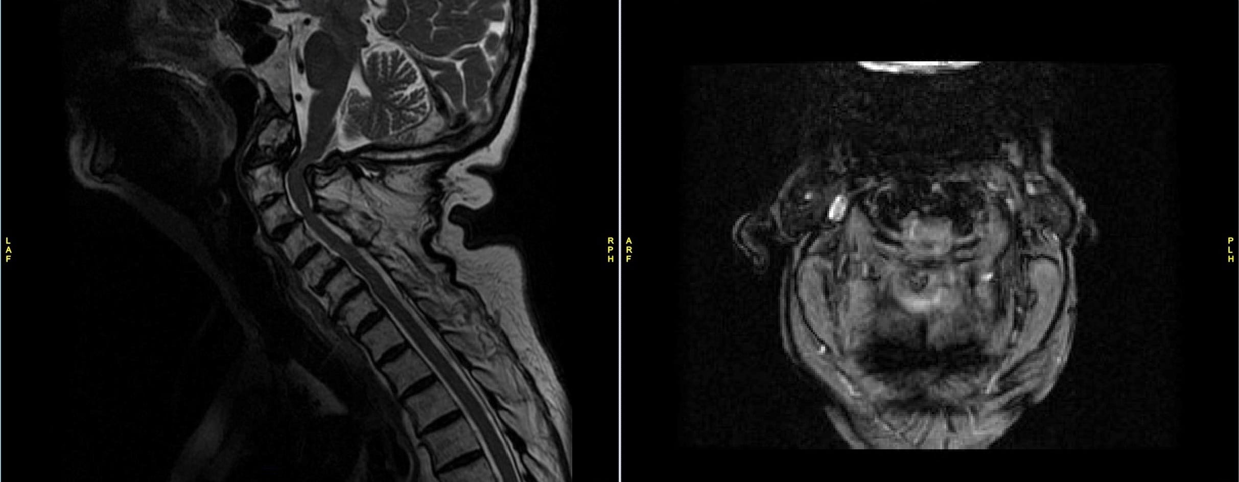 Resonancia magnética de la columna cervical que muestra estenosis crítica en C1-2 con pannus fibroso posterior en la fractura odontoides Resonancia magnética de la columna cervical que muestra estenosis crítica en C1-2 con pannus fibroso posterior en la fractura odontoides