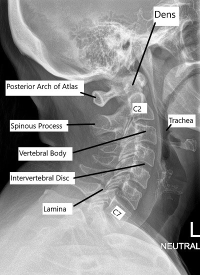 X-ray of the normal Cervical and Lumbar Spine. X-ray of the normal Cervical and Lumbar Spine.
