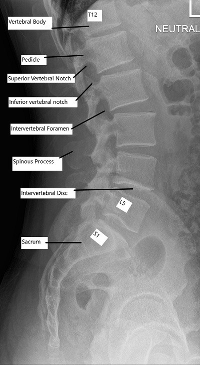 X-ray of the normal Cervical and Lumbar Spine. X-ray of the normal Cervical and Lumbar Spine.