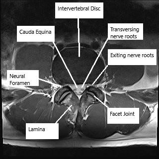 MRI showing the lumbar spine in the axial and sagittal section. MRI showing the lumbar spine in the axial and sagittal section.
