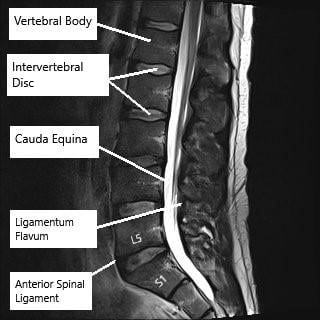 MRI showing the lumbar spine in the axial and sagittal section. MRI showing the lumbar spine in the axial and sagittal section.