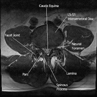 Axial section of the lumbar spine showing the facet joints. Axial section of the lumbar spine showing the facet joints.