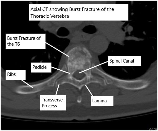 CT scan of the thoracic spine showing a burst fracture of the T6 vertebra CT scan of the thoracic spine showing a burst fracture of the T6 vertebra