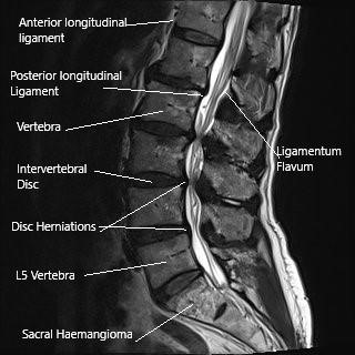 MRI of the lumbar spine in the sagittal section showing disc herniations narrowing the spinal canal. MRI of the lumbar spine in the sagittal section showing disc herniations narrowing the spinal canal.