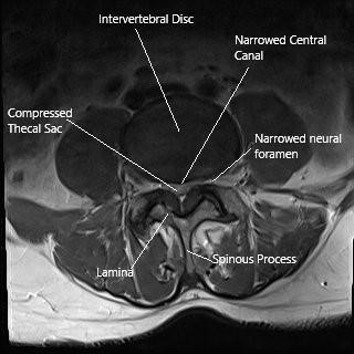 Axial section of the lumbar spine showing spinal stenosis and the lamina. Axial section of the lumbar spine showing spinal stenosis and the lamina.