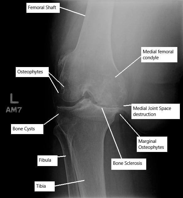 Advance osteoarthritis of the left knee joint on an X-ray. Advance osteoarthritis of the left knee joint on an X-ray.