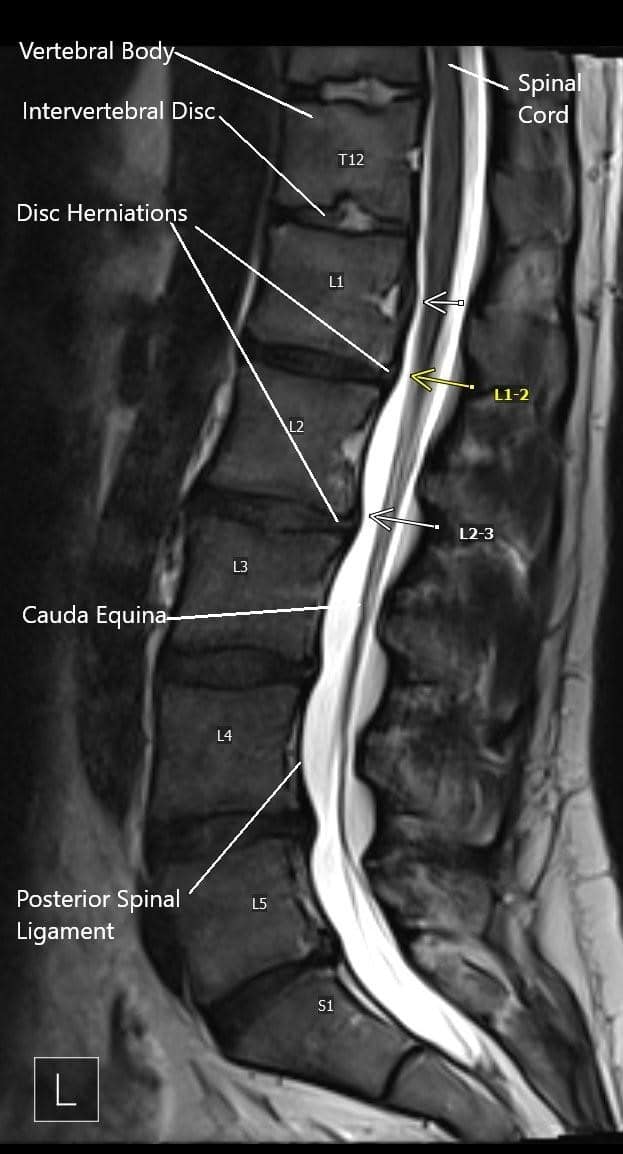 MRI image showing multiple disc herniations. MRI image showing multiple disc herniations.