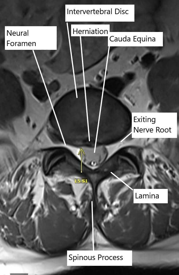 Axial section of the spine showing central disc herniation. Axial section of the spine showing central disc herniation.