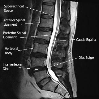 MRI of the lumbar spine in the sagittal section showing disc bulge. MRI of the lumbar spine in the sagittal section showing disc bulge.
