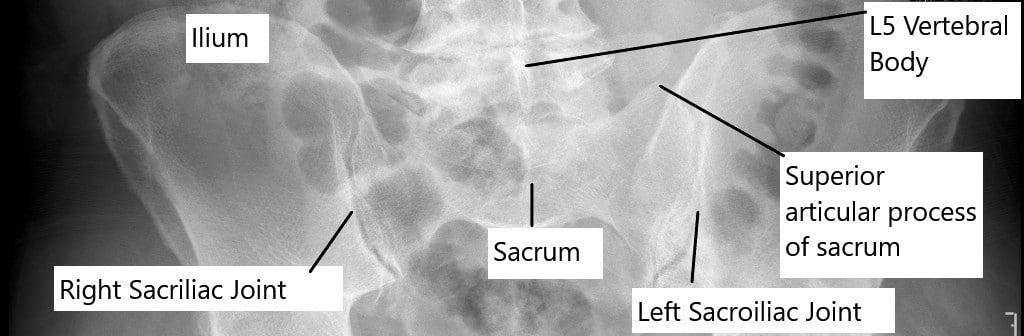 Bilateral sacroiliac joints as seen on X-ray of the pelvis in anteroposterior view. Bilateral sacroiliac joints as seen on X-ray of the pelvis in anteroposterior view.