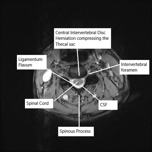 Axial section of the cervical spine showing disk herniation on MRI. Axial section of the cervical spine showing disk herniation on MRI.