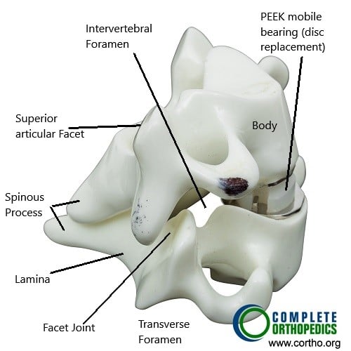 Cervical spine with prosthetic disc Cervical spine with prosthetic disc