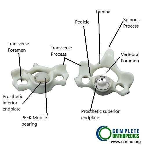 Total cervical disc replacement Total cervical disc replacement