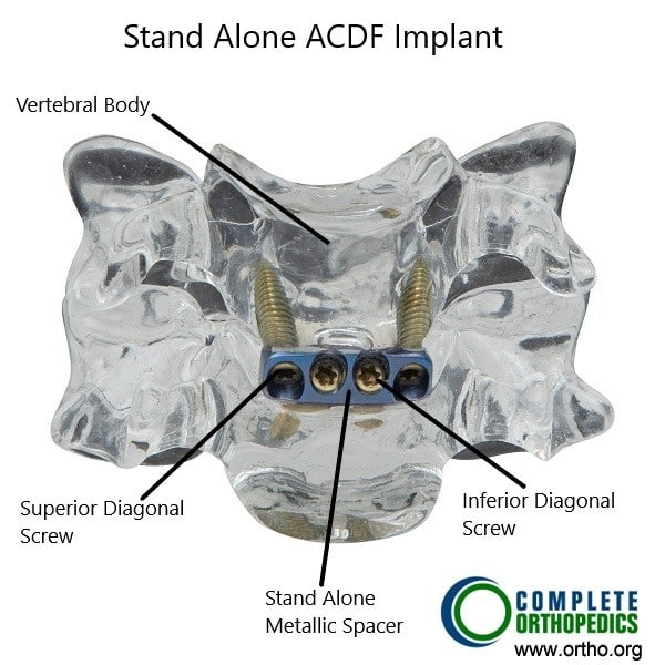 Stand Alone ACDF Implant. Stand Alone ACDF Implant.