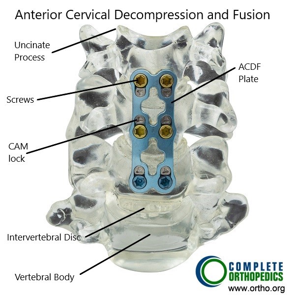 Anterior Cervical Decompression and Fusion Anterior Cervical Decompression and Fusion