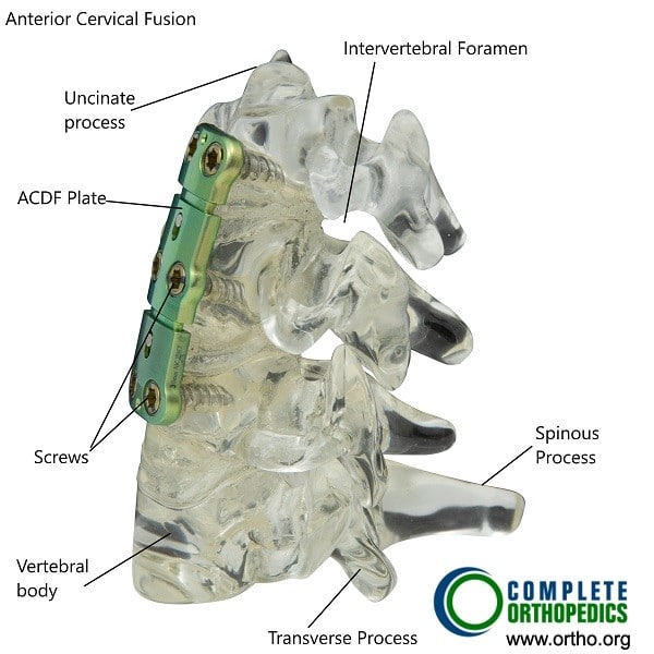 La fusión cervical anterior se puede hacer en casos graves de artritis e inestabilidad de la columna cervical como resultado de la artritis idiopática juvenil La fusión cervical anterior se puede hacer en casos graves de artritis e inestabilidad de la columna cervical como resultado de la artritis idiopática juvenil