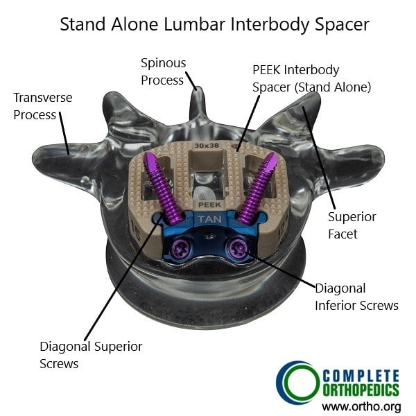 Stand alone interbody spacer used in MIS ALIF.