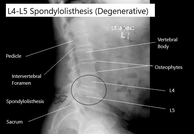 X-ray showing degenerative spondylolisthesis of the L4-L5 vertebrae. X-ray showing degenerative spondylolisthesis of the L4-L5 vertebrae.