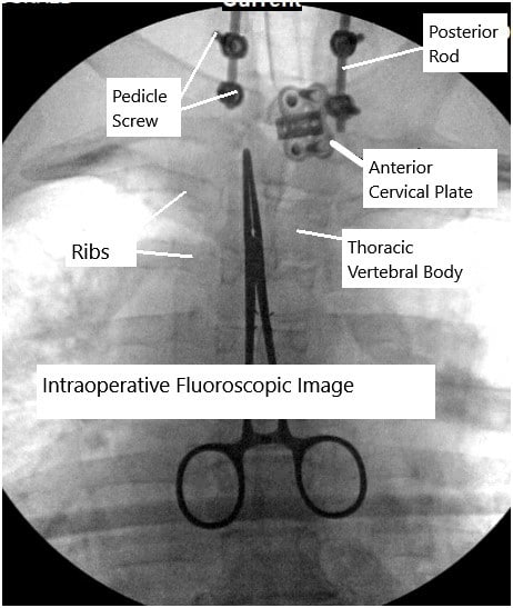 Combined anterior and posterior cervical spine surgery. Combined anterior and posterior cervical spine surgery.