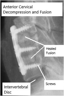 Healed and fused Anterior Cervical Decompression and Fusion. Healed and fused Anterior Cervical Decompression and Fusion.