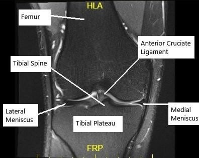 MRI of the knee in the coronal section showing an intact ACL. MRI of the knee in the coronal section showing an intact ACL.