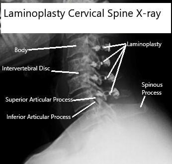 AP and Lateral view X rays of Laminoplasty C3-6 AP and Lateral view X rays of Laminoplasty C3-6