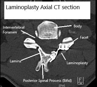 Axial CT scan Post-op Laminoplasty Axial CT scan Post-op Laminoplasty