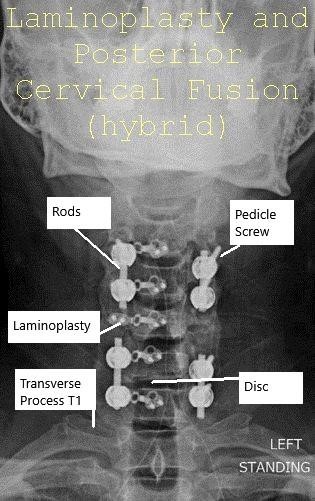 AP and Lateral view X-ray Post-op Laminoplasty and Posterior Spinal Fusion AP and Lateral view X-ray Post-op Laminoplasty and Posterior Spinal Fusion