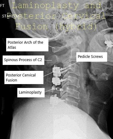 AP and Lateral view X-ray Post-op Laminoplasty and Posterior Spinal Fusion AP and Lateral view X-ray Post-op Laminoplasty and Posterior Spinal Fusion