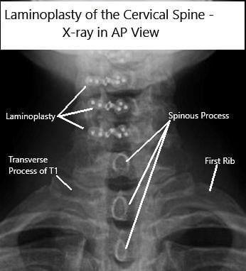 AP and Lateral view X rays of Laminoplasty C3-6 AP and Lateral view X rays of Laminoplasty C3-6