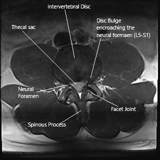 Axial section of the spine at L5-S1 level on an MRI