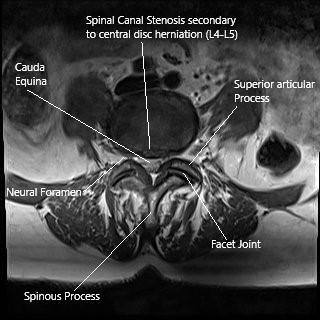 MRI of the Lumbar spine in axial section central disc herniation. MRI of the Lumbar spine in axial section central disc herniation.