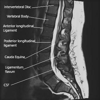 MRI of the lumbosacral spine in sagittal section. MRI of the lumbosacral spine in sagittal section.