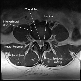MRI image showing the axial section of the lumbar spine. MRI image showing the axial section of the lumbar spine.