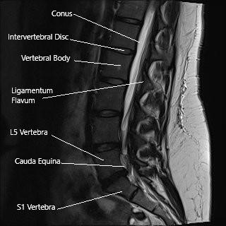 Sagittal section of the lumbosacral spine on MRI. Sagittal section of the lumbosacral spine on MRI.